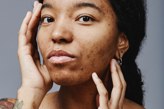 Hyperpigmentation: Causes, Solutions & The Shea Radiance Brightening Regimen