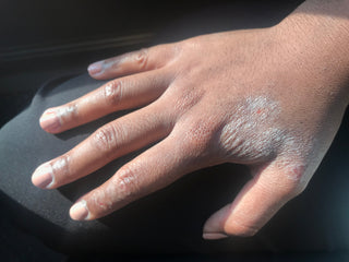 Eczema-Prone Skin — Body Care Concern & Solution